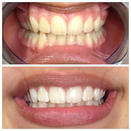 Before and After Teeth Whitening in Denver