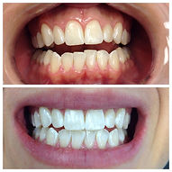 Before and After Teeth Whitening in Denver