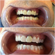 Before and After Teeth Whitening in Denver