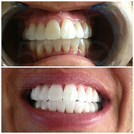 Before and After Teeth Whitening in Denver