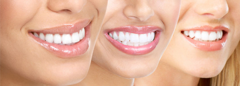 teeth-whitening-zampieri-dental-care-fort-lee-nj.jpg